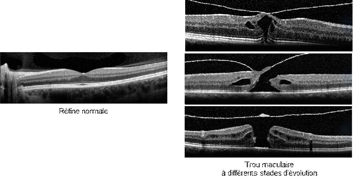 Trou-maculaire_img1