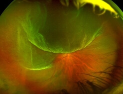 photo_myopie-forte_02